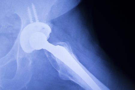 Hip Implant