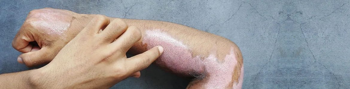 burnt skin of a person's arms